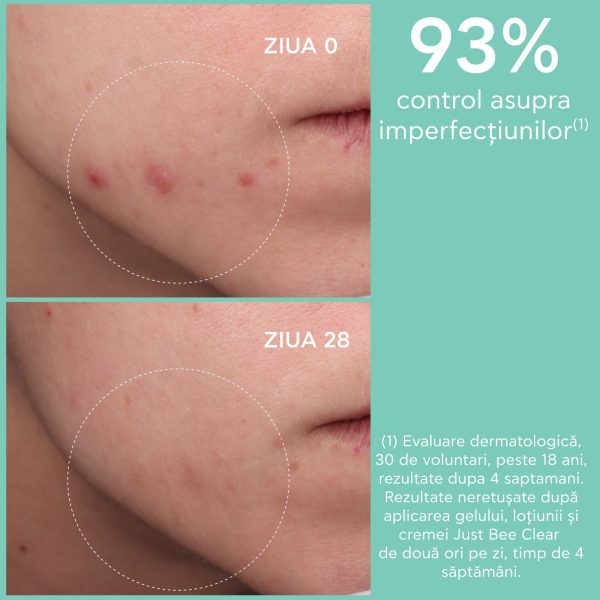 crema matifianta anti acnee cu 5 niacinamide acid salicilic vegetal si propolis patentat amc 40ml apivita 125304